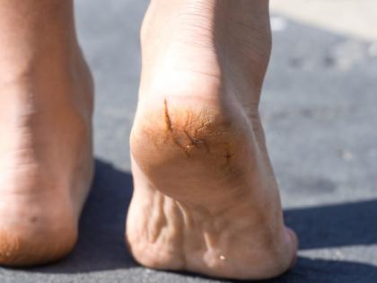 pain-of-cracked-feet-unbearable-start-using-home-remedies | पायांच्या भेगांचे दुखणे असह्य झाले आहे? घरीच करा 'हे' उपाय