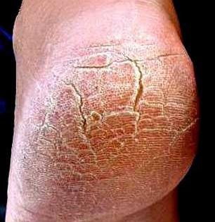 हिवाळ्यात टाचांना भेगा पडल्या- चालता येत नाही? मेणात कालवा ४ गोष्टी, सोपा उपाय - भेगा होतील कमी