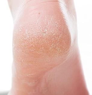 टाचांच्या भेगा खूप वाढल्या, चालताना दुखते? ग्लिसरीनमध्ये मिसळून लावा १ पदार्थ- टाचा होतील मऊ