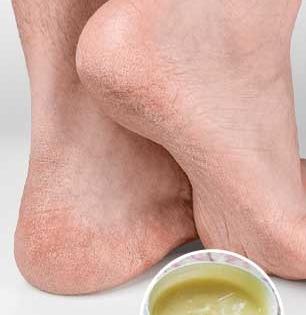 तळपायांना पडलेल्या भेगा काही दिवसांतच होतील गायब- 'हे' घरगुती क्रिम वापरा- टाचा होतील मऊ, कोमल