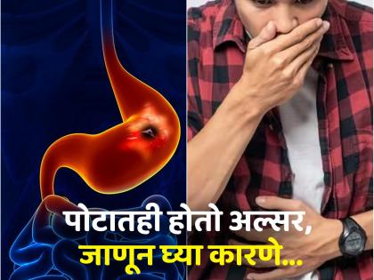 Stomach ulcer causes, symptoms and tips to avoid it | तोंडाचा अल्सर माहीत असेलच, आता पोटाच्या अल्सरची लक्षणे, कारणे अन् बचावाचे उपाय वाचा!