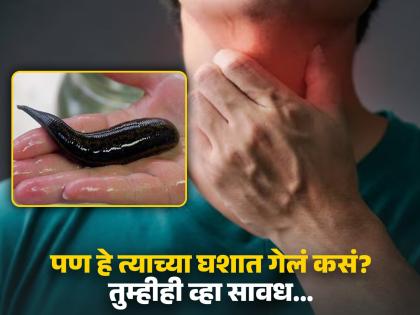 Man with hoarse voice bleeding mouth doctor finds leech attached to his throat | व्यक्तीचा आवाज बदलला होता, डॉक्टरांनी पाहिलं तर दिसला भयावह जीव...