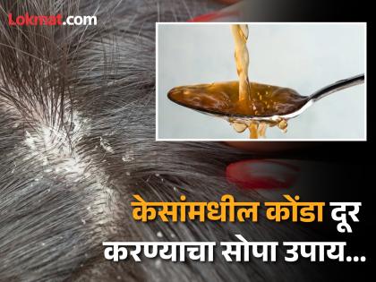 How to get rid of dandruff with apple cider vinegar, Dermatologist tells the way | केसांमधील कोंडा दूर करण्यासाठी करा हा सोपा उपाय, डर्मेटोलॉजिस्टने सांगितली पद्धत