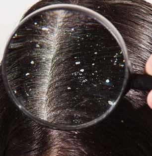 तुमच्या डोक्यात ओला कोंडा झाला आहे की कोरडा? चुकीचे उपाय करुन वाढतो त्रास, पाहा कोंड्याचा प्रकार