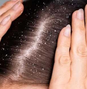 हिवाळ्यात डोक्यातला कोंडा खूपच वाढला? स्वयंपाक घरातले ४ पदार्थ लावा, काही दिवसांतच कोंडा गायब