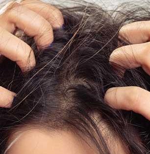 टाळूवर लाल चट्टे-चाई पडल्यासारखे केस गेले-कोंडाही भरमसाठ, करा ५ उपाय-आग न होता त्रास होईल कमी