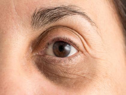 Dark circles treatment how to reduce dark circles home remedies for dark circles | 'या' तीन घरगुती उपायांनी गायब होतील डार्क सर्कल्स; असा करा वापर