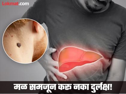 Liver disease can cause a number of symptoms on the neck | गळ्यावर काळपटपणा आणि चामखीळ लिव्हरच्या 'या' आजाराचा संकेत, जाणून घ्या लक्षणं....