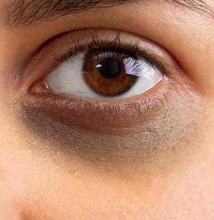 काकडी-बटाटा विसरा! डार्क सर्कल्स, डोळ्यांखालची सूज घालवण्यासाठी सोपा घरगुती उपाय, आठवड्याभरात दिसेल फरक