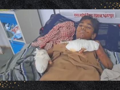 chhatarpur blast in bluetooth speaker battery during lisitning song boy injured | भयंकर! गाणी ऐकताना ब्लूटूथ स्पीकरच्या बॅटरीचा भीषण स्फोट; 13 वर्षीय मुलगा गंभीर जखमी