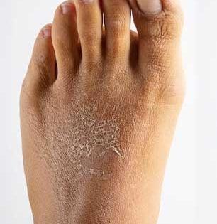 थंडीत तळपायांच्या भेगा वाढल्या, रक्तही येतं? 'हा' होममेड फुटमास्क लावा- पाय होतील मऊ-भरतील भेगा