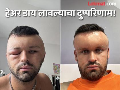 England Man's Head Swells After Hair Dye Reaction | हेअर डाय लावणं तरूणाला पडलं महागात, सकाळी फुग्यासारखा फुगला होता चेहरा!