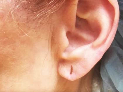 What is a swimmer's ear infection? Know the symptoms and remedies | स्विमर्स इअर इन्फेक्शन म्हणजे काय? जाणून घ्या लक्षणे अन् उपाय