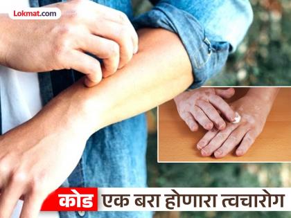 कोडावर उपाय : योग्य काळजी घेतल्यास हा त्वचारोग होऊ शकतो पूर्णपणे बरा!