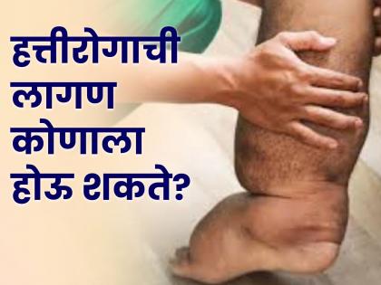 health tips for elephantiasis know its causes symptoms and treatment what experts say | हत्तीरोग म्हणजे काय? कशामुळे होतो हा रोग, आळा घालणे शक्य आहे का? जाणून घ्या