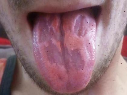 OMG! This man drank six energy drinks daily claims tongue damage | एनर्जी ड्रिंक्समुळे याच्या जिभेची झाली ही हालत, दिवसाला घेत होता ५ ते ६ ड्रिंक्स