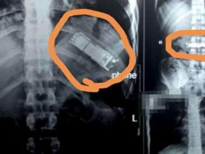बापरे! ७ महिन्यांपासून पोटातून येत होता रिंगटोनचा आवाज; डॉक्टरांनी सर्जरी केली अन् मग....