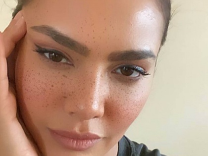 Did you know this Bollywood actress shared a photo with facial scars? TJL | बॉलिवूडच्या या अभिनेत्रीला ओळखलंत का, शेअर केला चेहऱ्यावरील डागांसोबतचा फोटो