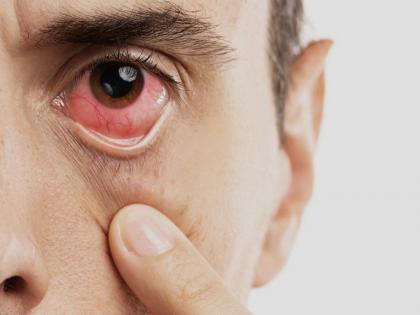 State-wide eye disease due to 'adeno virus'; What are the symptoms? Take care like this | ‘ॲडिनो व्हायरस’मुळे राज्यभर डोळ्यांची साथ; काय आहेत लक्षणे? अशी घ्या काळजी