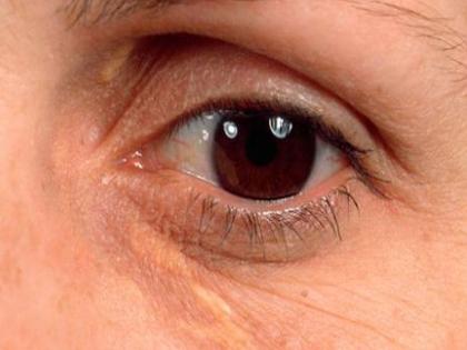 How to get rid cholesterol deposits around your eyes | डोळ्यांखालील सूज कमी करण्यासाठी 'हे' घरगुती उपाय करतील मदत!