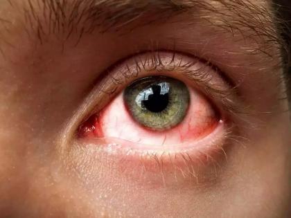 your eye flue will turn red; In Pune district, 35 thousand people got their eye infrction | Pune: काळजी घ्या, नाहीतर तुमचेही डोळे लाल; पुणे जिल्ह्यात ३५ हजार जणांना आले डोळे