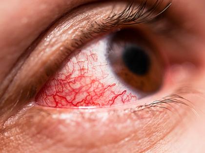 causes symptoms remedies of diabetic retinopathy | 'या' गंभीर आजारामुळे तुम्हाला येऊ शकत कायमच अंधत्व, वेळीच ओळखा लक्षणे अन् उपाय