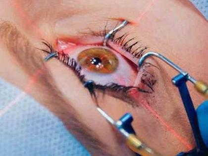 Decrease in eye surgery in government hospitals | सरकारी रुग्णालयांतील नेत्र शस्त्रक्रियेत घट