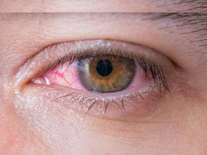 woman ignored swelling in eye doctor diagnosed this deadly tumour disease | डोळ्यातील सूजेकडे दुर्लक्ष करणं महिलेला पडलं चांगलंच महागात; झाला गंभीर आजार अखेर...