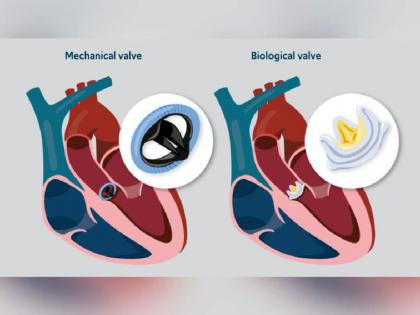 Hundreds of patients are dying with bad valve without treatment | उपचाराविनाच खराब ‘व्हाॅल्व्ह’सह मृत्यूच्या दाढेत जगताहेत शेकडो रुग्ण