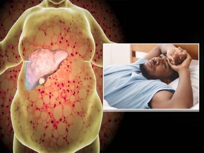 Fatty liver disease : Long daytime naps linked to higher risk of chronic liver disease | Fatty liver disease : फॅटी लिव्हरचा धोका वाढवते रात्री केलेली ही चूक, लिव्हर होतं खराब!