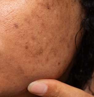 पिंपल्स तर जातील पण डागांचे काय ? चेहरा निस्तेज करणारे हे डाग करा गायब - अगदी सोपे उपाय ठरतील उपयुक्त