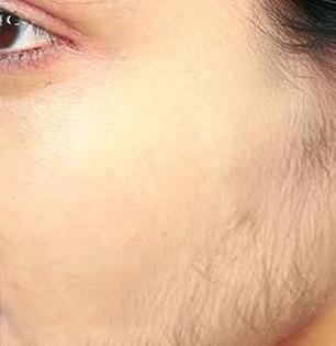 फेशियल हेअर रिमूव्हलचा घरगुती उपाय! वेदना न होता केस निघतील सहज - वॅक्सिंग, थ्रेडींग विसरा!