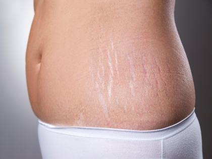 solution for remove stretch marks | स्ट्रेच स्मार्क्सची समस्या होईल कायमची दूर, जाणून घ्या हे उपाय 