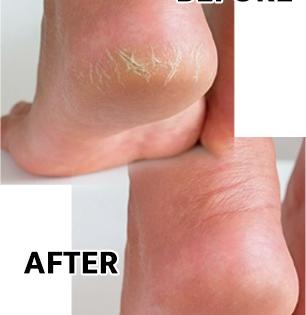 Best Tips to care Cracked Heal : फुटलेल्या टाचा ७ दिवसात मऊ, मुलायम होतील; रोज रात्री पायांना ३ लावा वस्तू 