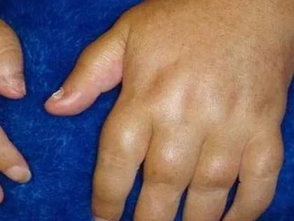 If the fingers swell in winter? Do this solution health care tips arthritis | हिवाळ्यात बोटांना सूज आली तर? ‘हे’ करा उपाय 