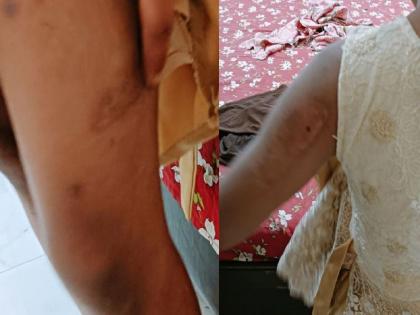 Cruelty that shames even the devil... A 10-year-old girl was tortured by being locked in a room, with pan-cigarette burns all over her body. | सैतानालाही लाजवणारे क्रौर्य... १० वर्षांच्या मुलीवर खोलीत कोंडून अत्याचार, सर्वांगावर चटके