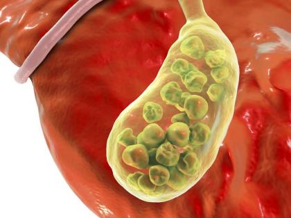 What is gallbladder stones and who is most at risk? | कुणाला असतो गॉल ब्लॅडर स्टोनचा सर्वात जास्त धोका?