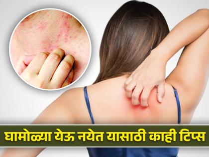 summer care tips home remedies for body rashes and itching  | उन्हाळ्यात घामोळे आल्यावर काय करावं? हे घरगुती उपाय करा; खाज, पुरळ होईल दूर  