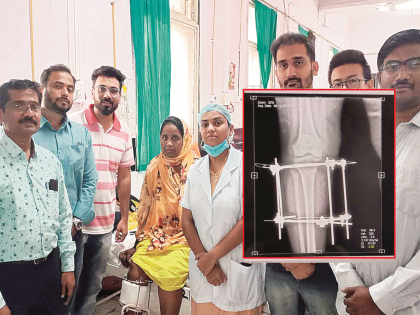 The woman's bent leg was cut below the knee bone and straightened, avoiding joint replacement | महिलेचा वाकलेला पाय गुडघ्याखालील हाड कापून केला सरळ; सांधेरोपण, मोठी शस्त्रक्रिया टळली