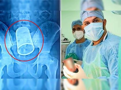 Drunk man gets a 55 inch long steel cup removed from his stomach doctors surprised in Bihar | तरूणाच्या पोटातून काढला 5.5 इंच लांब स्टीलचा ग्लास, एक्स-रे बघून डॉक्टर हैराण, आत गेला कसा?