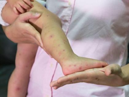 First death of child of measles govar in Thane municipal limits; The disease started to spread | ठाणे पालिका हद्दीत गोवरचा पहिला बळी; आजार हातपाय पसरू लागला