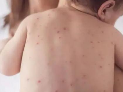 Health: Why outbreak of measles? | Health: का होतोय गोवराचा उद्रेक?