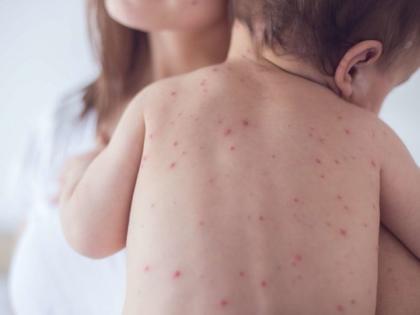 Aurangabad Named Among 11 Measles Affected Cities in State | राज्यातील ११ गोवरग्रस्त शहरांत औरंगाबादचे नाव, पालकांकडून लसीसाठी विचारणा