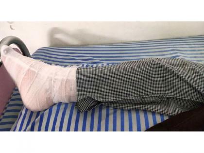 Banned nylon manja stucks in girl's leg and cut the leg bone | पायात मांजा अडकला अन् तरुणीच्या पायाचे हाडच कापले