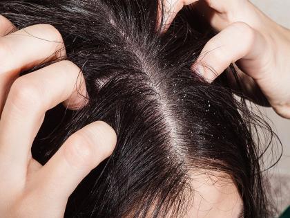 Try these natural ways to get rid of dandruff problem this winter season | हिवाळ्यात वाढते डॅंड्रफची समस्या, 'या' घरगुती उपायांनी करा दूर!