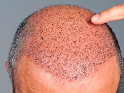 Beauty Tips : Important things about hair transplant | हेअर ट्रान्सप्लांट करणे बरोबर की चुकीचे? जाणून घ्या खास गोष्टी!