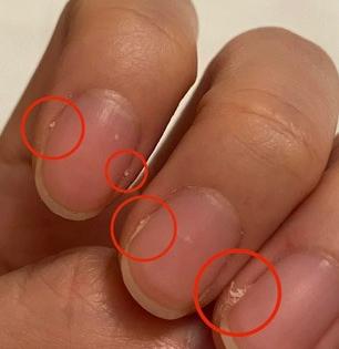 नखांच्या आजूबाजूची त्वचा निघत असेल तर काय करावं? पाहा का होते ही समस्या