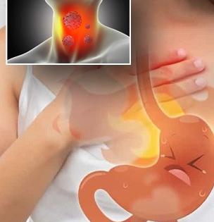 सतत छातीत जळजळ होणं पित्ताचा त्रास, पण कॅन्सरचाही वाढू शकतो धोका-पाहा लक्षणं..