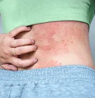 अंगावर उठणारे बारीक पुरळ म्हणजे नक्की काय ? शरीराच्या उष्णतेत वाढ झाल्यास होतो वेगळाच त्रास