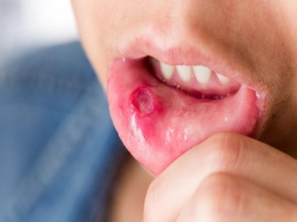 home remedies for mouth ulcers | वारंवार तोंड येत आहे; करा 'हे' उपाय